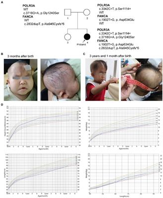A synonymous variant contributes to a rare Wiedemann-Rautenstrauch syndrome complicated with mild anemia via affecting pre-mRNA splicing